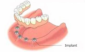 Dental Implant treatment