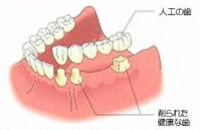 ブリッジによる治療法