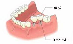 インプラントによる治療法