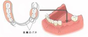 部分入れ歯による治療法