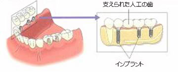 インプラントによる治療法