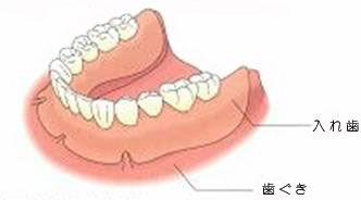 総入れ歯による治療法
