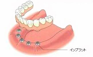 インプラントによる治療法