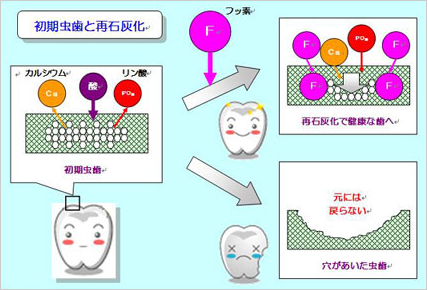 再石灰化