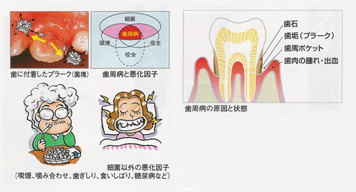 歯周病の原因