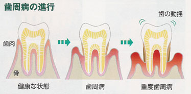 歯周病の原因