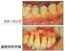 歯周病の治療はどのように行われるの？