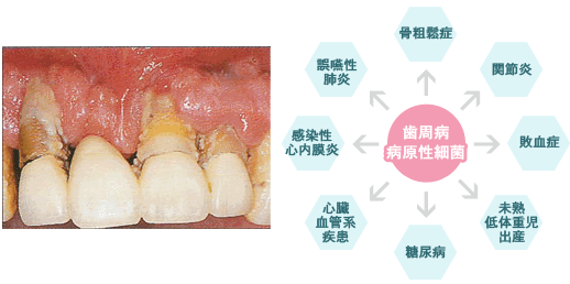 歯周病が全身に及ぼす影響とは？