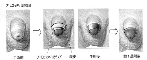 腫れ ほう 後 けい 手術