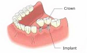 Dental Implant Treatment