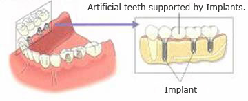 Dental Implant Treatment