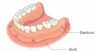 Full denture treatment