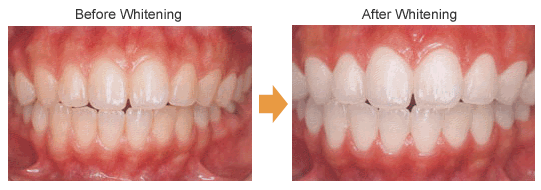 IN-Office Teeth Whitening