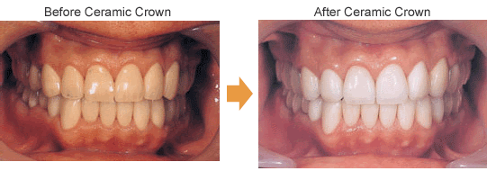 Ceramic Crowns, Hybrid Crowns