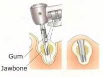 The first implant surgery