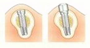 The second implant surgery