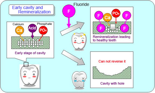 Fluoride