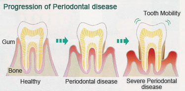 How does gum disease progress?