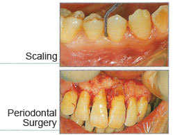 How is Periodontal Disease Treated?