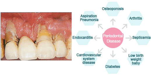 How does periodontal disease affect overall health?